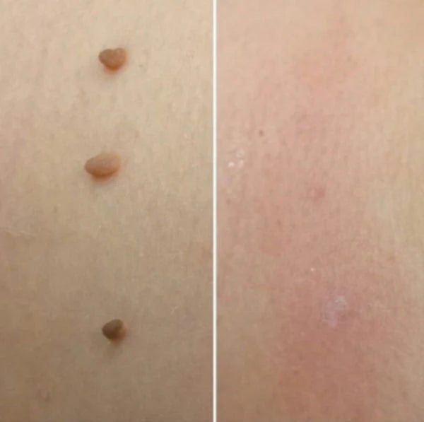Healthbeam Skin Tag Removing Kit
