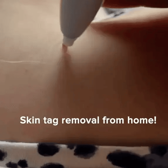 Healthbeam Skin Tag Removing Kit
