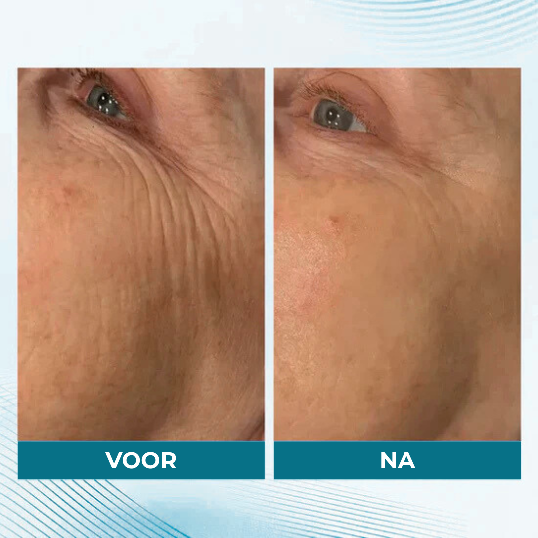 Healthbeam - Skin tightener